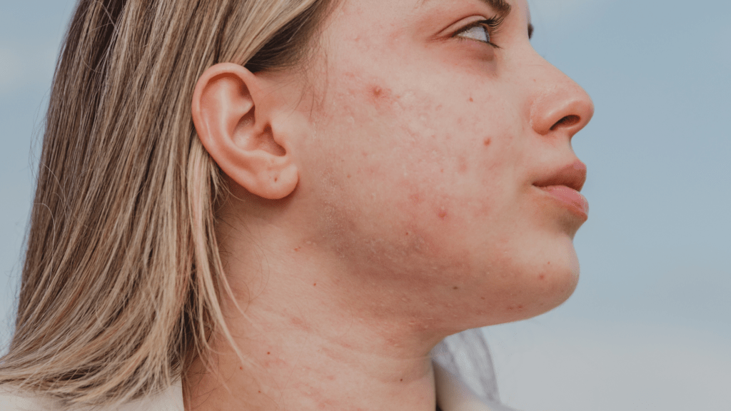Combining Accutane and Alcohol