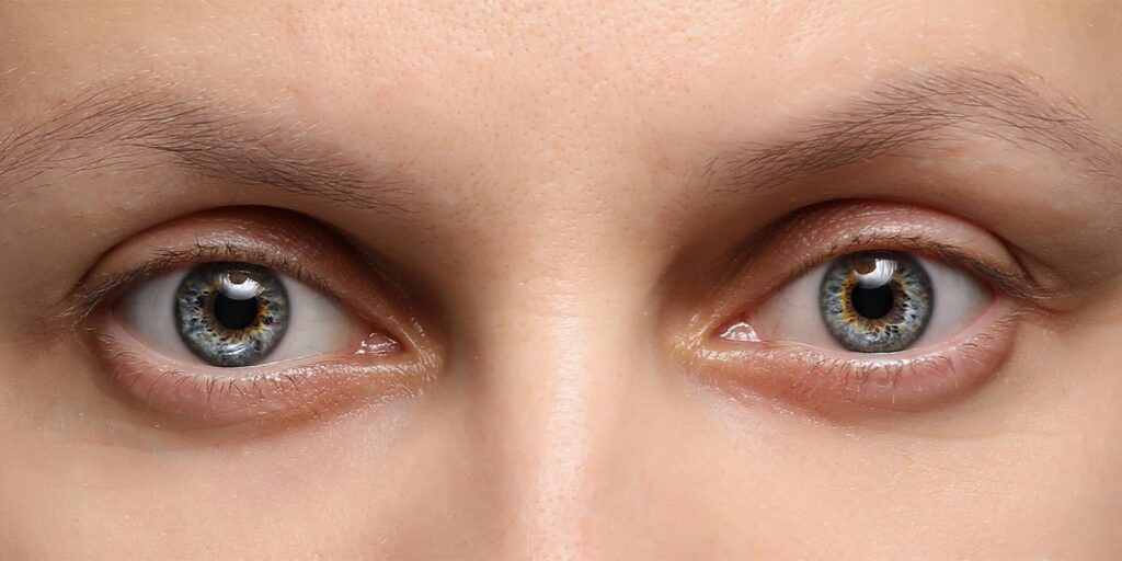 Dilated-Pupils